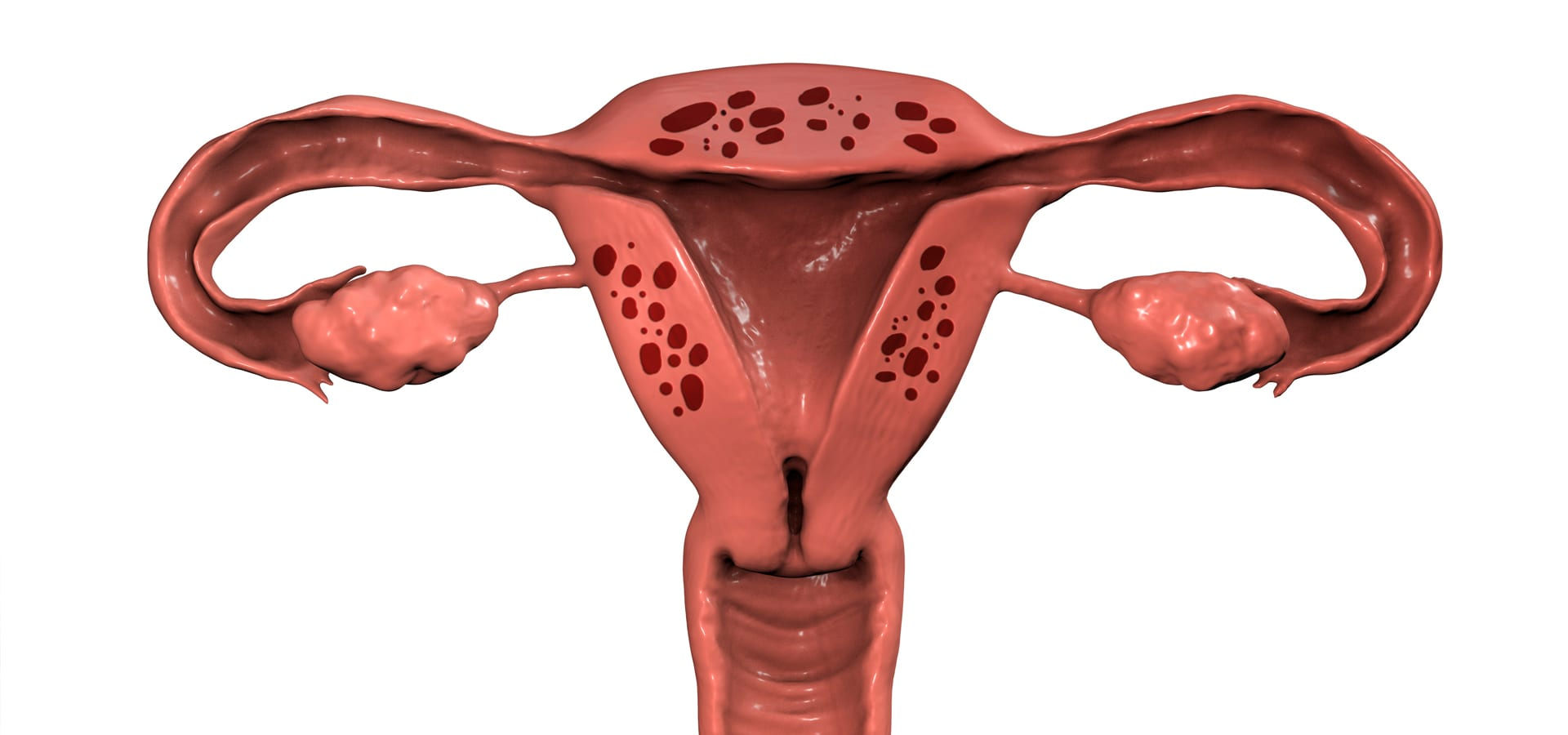 Adenomiose - Dra. Laís Fonseca